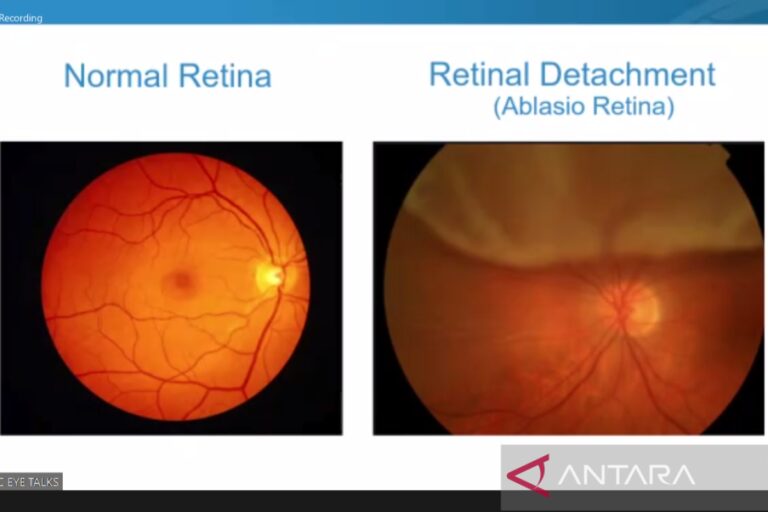 Usia 40 tahun ke atas rentan terkena ablasio retina