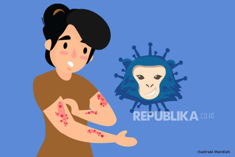 Virus Mpox Bisa Menular Lewat Kontak Langsung Lesi Kulit Hingga Droplet